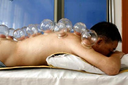 chinese-acupuncture-cupping